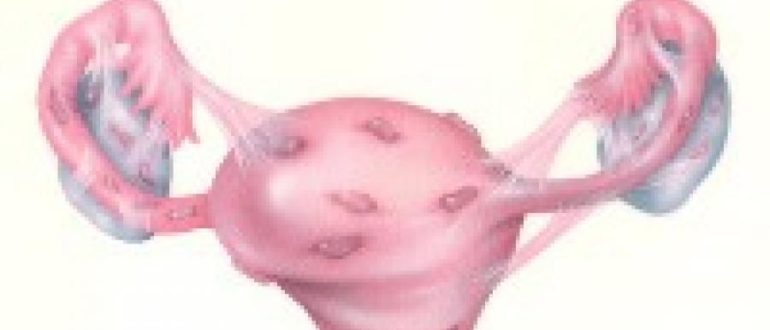 Вторичное бесплодие, эндометриоз и жанин