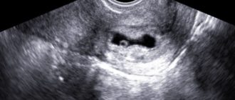 Деформировано плодное яйцо