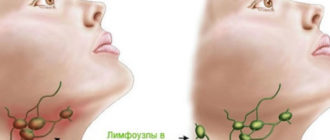 Воспаляется лимфоузел