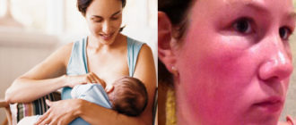 Крапивница во время грудного вскариливания