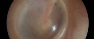 Вода в ухе с перфорированной барабанной перепонкой