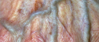 Микротрещины половых губ, то это?