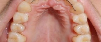 Чешется небо до ранок во рту