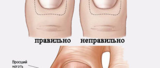 Вросший ноготь