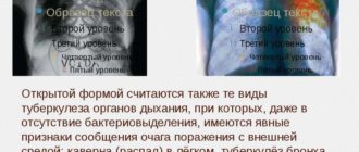 Возможно ли отличить туберкулез от лимфомы