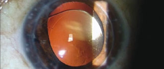Вижу край ИОЛ