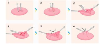 Что делать, втянутые соски?