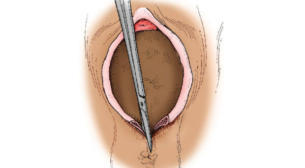 Влагалище после родов