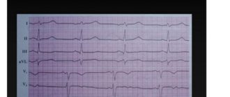 Эктопический предсердный ритм