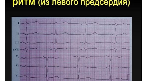 Эктопический предсердный ритм