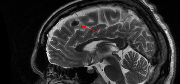 МРТ ГМ. Единичный очаг демиелинизации. Ассиметрия ПА