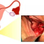 Воспаление влагалища и язвочки на половых губах после ПА
