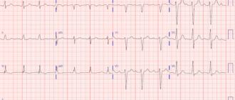 Экг, тахикардия после родов