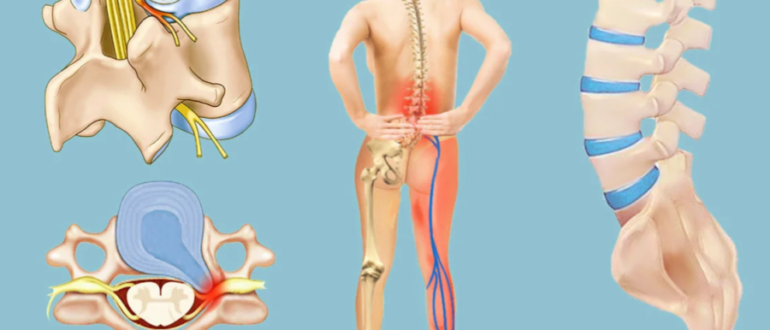 Можно ли рожать самой с межпозвоночной грыжей в пояснице?