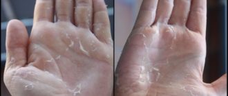 Кожа на ладошках местами облазит