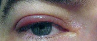 Набряк ока опущена повійка