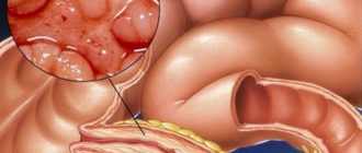Энтероколит и колоноскопия