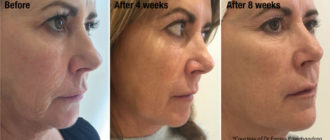 Длительные отёки после укола Профайло (Profhilo)