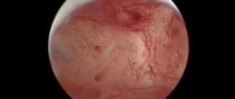Черные выделения после лечения хронического эндометрита