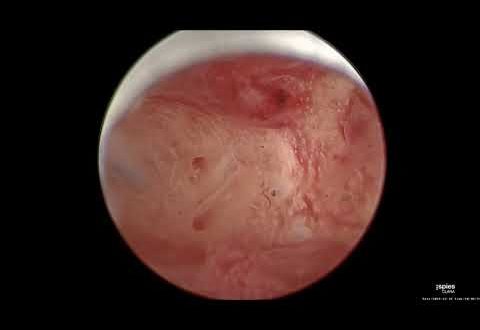 Черные выделения после лечения хронического эндометрита