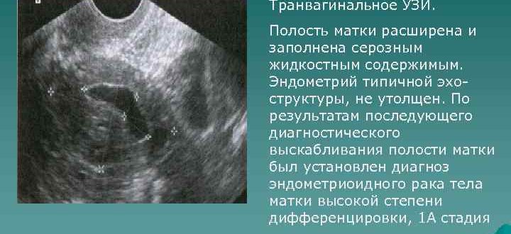 Что значит полость матки расширена за счет неоднородного содержимого