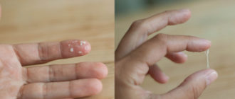 Выделения мелкими катышками