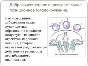 Доброкачественное позиционное головокружение