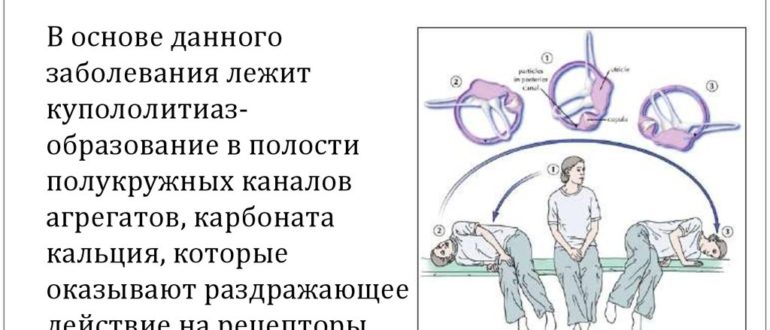 Доброкачественное позиционное головокружение