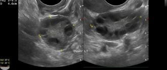 Мультифолликулярные яичники и беременность