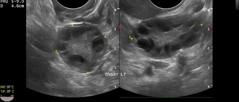 Мультифолликулярные яичники и беременность