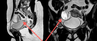Можно ли заменить гистероскопию МРТ матки и яичников?