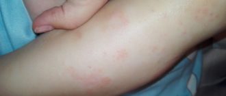 Что за сыпь на сгибе ноги у ребенка
