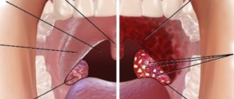 Что за шарик в горле справа (фото приложено)?