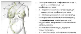 Диагноз С77 Mts в подмышечные узлы слева без ВПО. Гр 2?