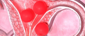 Эндометриоз и полип