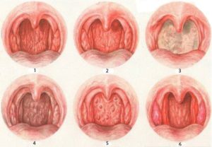 Вторичный хронический фарингит