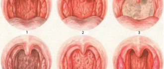 Вторичный хронический фарингит