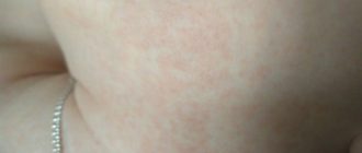 Возможный контакт с больным корью при ГВ