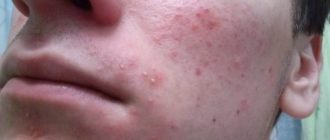 Ужасные высыпания на лице (гнойные прыщи), из-за повышенного уровня тестостерона