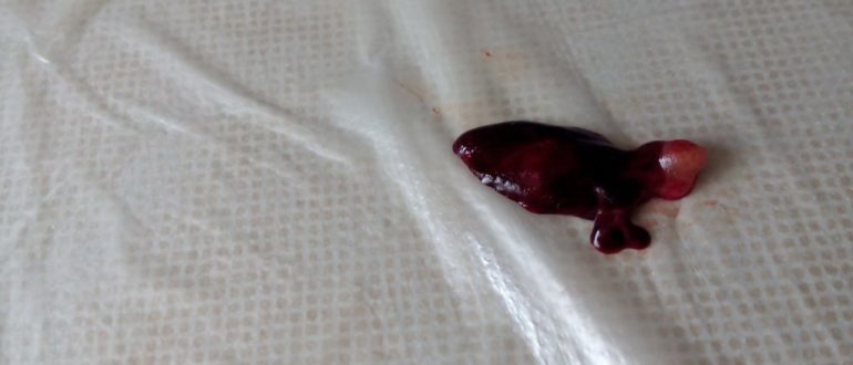 Месячные стали более скудные после выкидыша