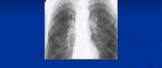 Эмфизема лёгких и диффузный пневмосклероз