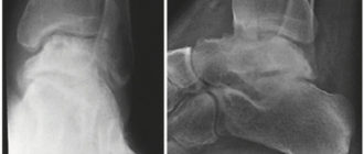 Воспаление на таранной кости