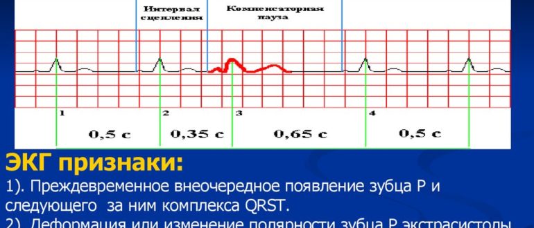 Экстрасистолия с утра на тощак