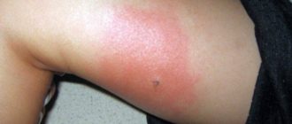 Красная полоса от места укуса насекомым