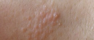 Водянистые шишки на теле с зудом