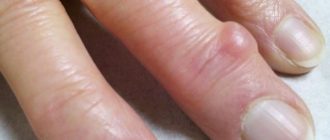 Нарост на пальце в виде кисты