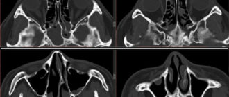 На мрт сфеноидит