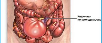 Может ли развиться кишечная непроходимость в следствие запора?