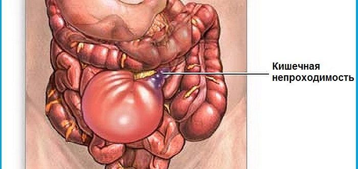 Может ли развиться кишечная непроходимость в следствие запора?