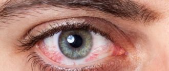 Cухость глаз